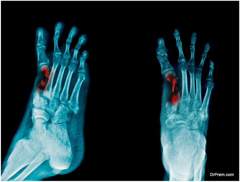 Osteomyelitis