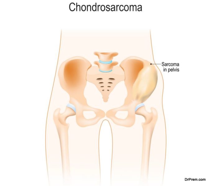 chondrosarcoma