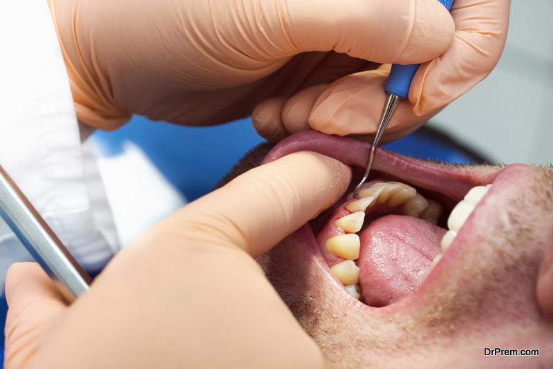 men are at greater risk for losing their teeth than women