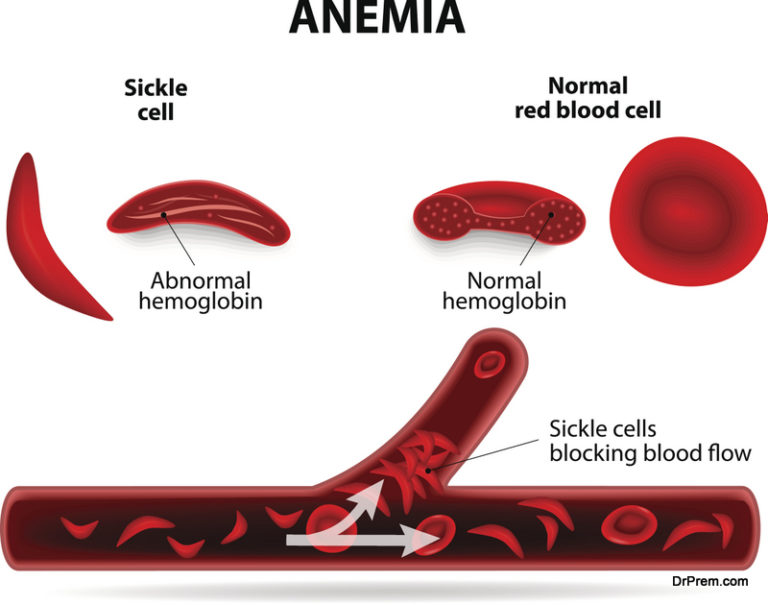 How And When To Self Test For Anemia Diy Health Do It Yourself Health Guide By Dr Prem 4913