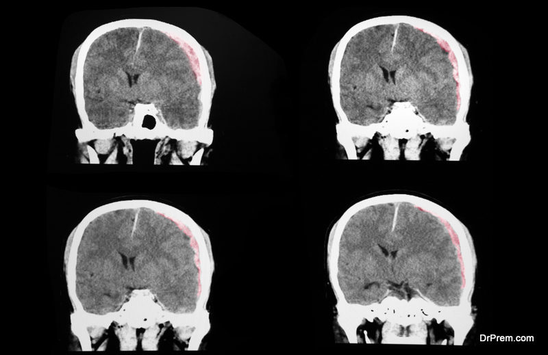 Cerebral Edema