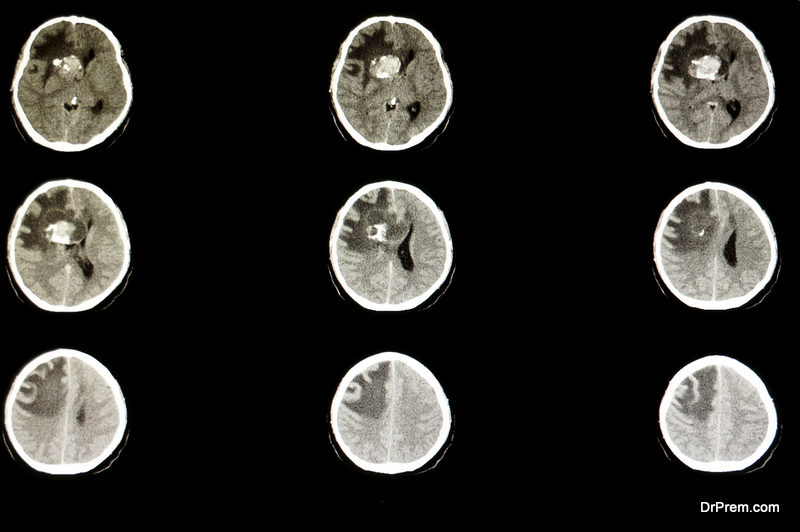 Cerebral Edema