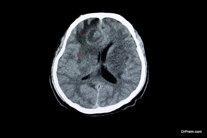 Cerebral Edema