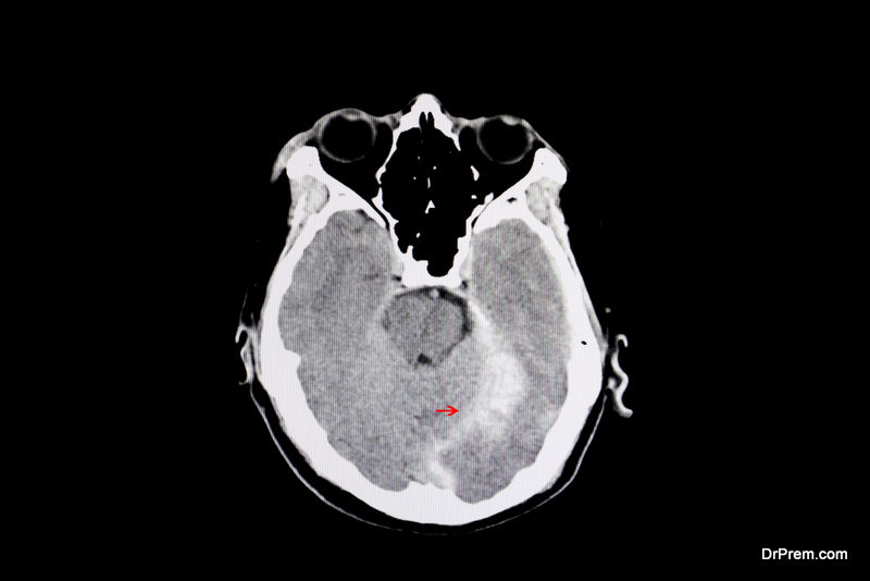 Cerebral Edema