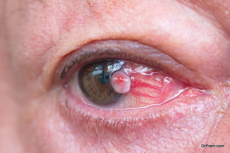 Common Eye Injuries