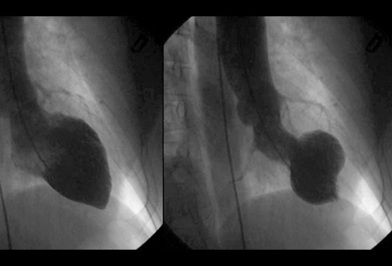 Takotsubo-Cardiomyopathy