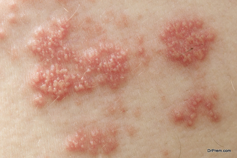 skin rash