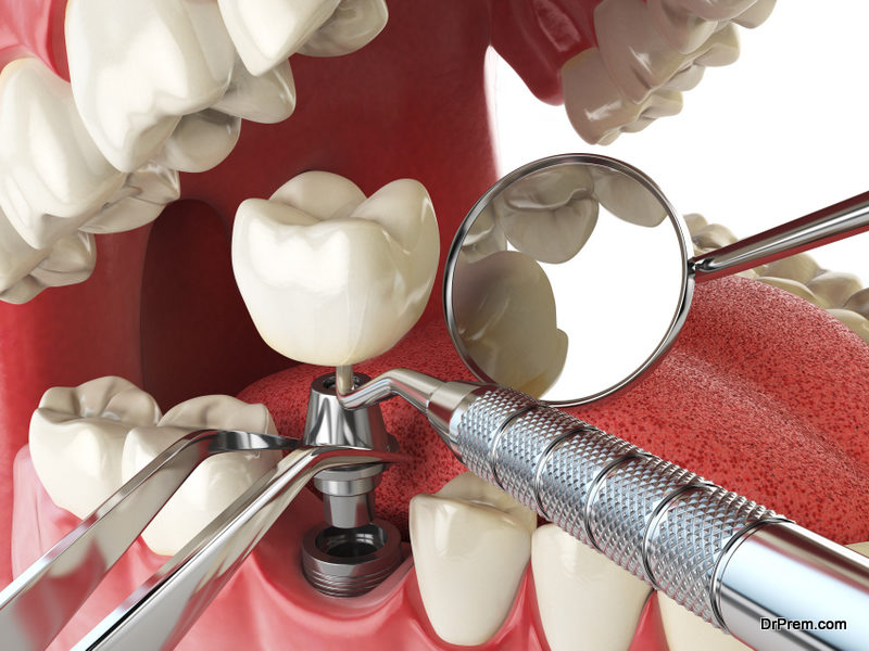 Dental-Implant