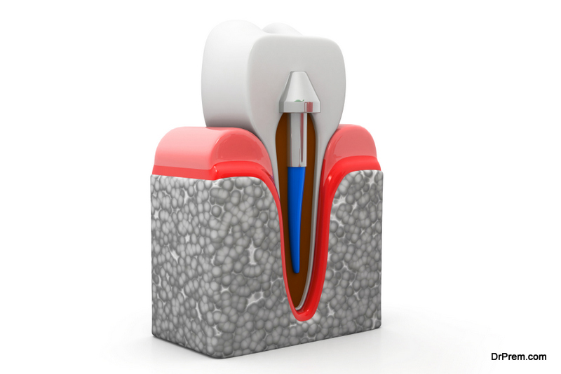 Dental-Implant