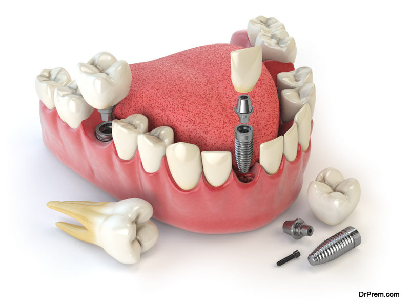 Dental-Implant