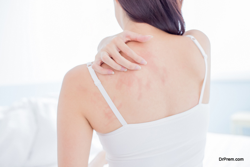 Treat Eczema at Home