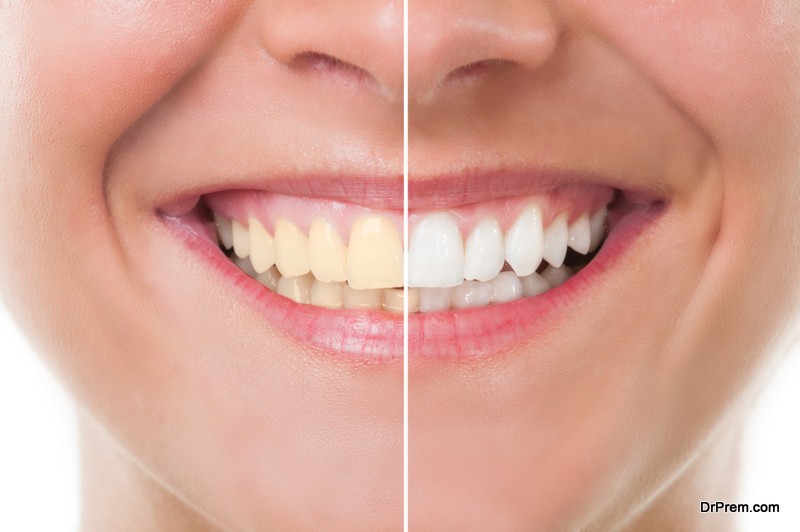 Do’s and Don’ts of Whitening your Teeth