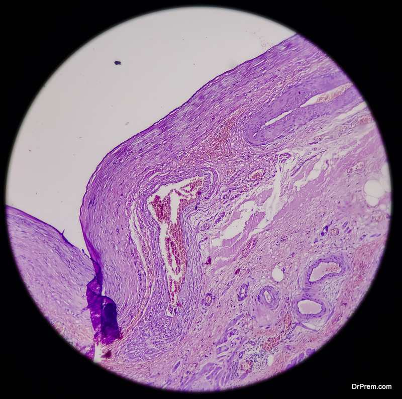 Tissue from endometrial polyp Ovarian polyp